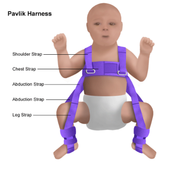 Developmental Dysplasia of the Hip (DDH)