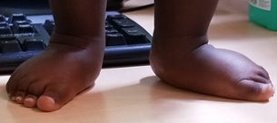 Flat Foot